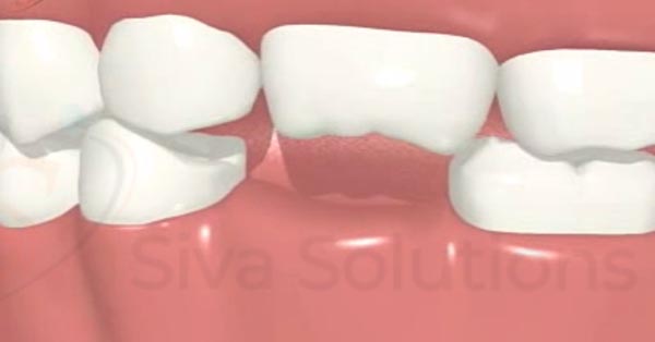 Dental Implant 101