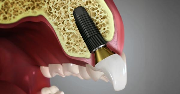 Dental Implant Process Take Time
