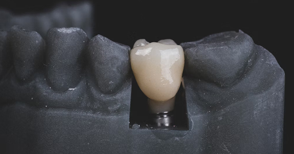 Dental Implants: A Great Alternative to Dentures and Bridges