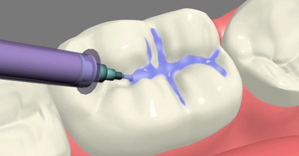 Dental Sealants Decrease Risk of Tooth Decay