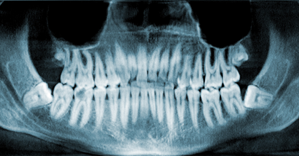 Impacted Teeth: What You Need to Know for Successful Removal and Recovery