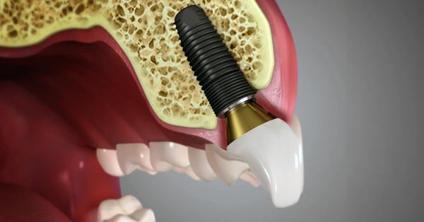 New Implant Advancement Hopes to Lower Risk of Infection