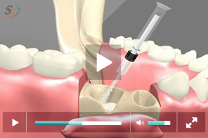 Bone Grafting - Scenario I Bone Grafting - Scenario I