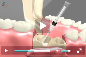 Bone Grafting - Scenario II Bone Grafting - Scenario II