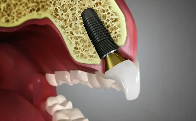 Dental Implants Largo MD